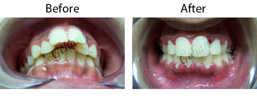Rekha Gehani, DDS | Digital Radiography, Traditional Metal Braces and Orthodontic Emergencies