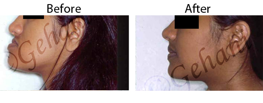 Rekha Gehani, DDS | Orthodontic Emergencies, Adult Orthodontics and Orthodontics for Teens