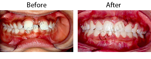 Rekha Gehani, DDS | Interceptive Orthodontics, Orthodontic Retainers and Orthodontics for Teens