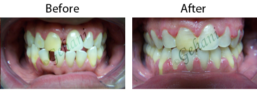 Rekha Gehani, DDS | Adult Orthodontics, Orthodontic Emergencies and Clear Ceramic Braces