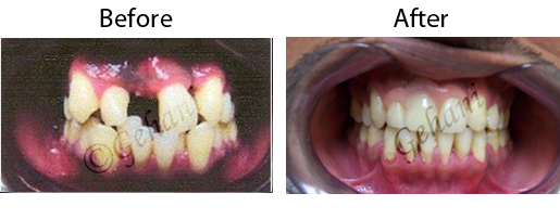 Rekha Gehani, DDS | Adult Orthodontics, Orthodontic Appliances and Interceptive Orthodontics