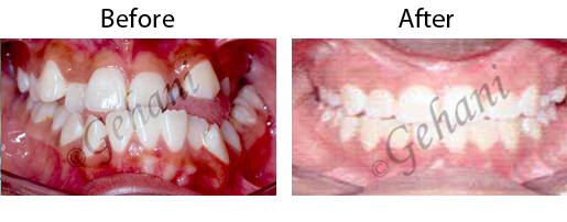 Rekha Gehani, DDS | Orthodontics for Teens, Traditional Metal Braces and Orthodontic Emergencies