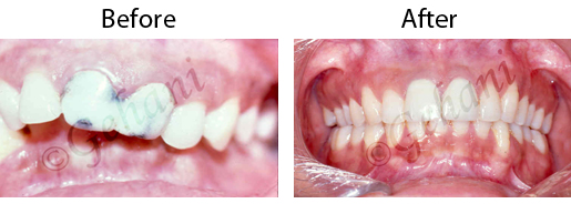 Rekha Gehani, DDS | Orthodontic Appliances, Invisalign reg  and Orthodontics for Teens